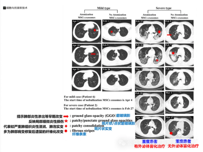 外泌體霧化對(duì)肺部炎癥損傷有良好治療作用